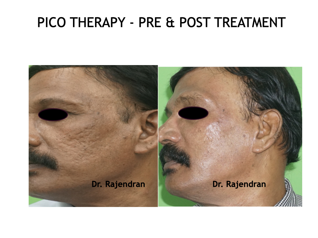 PIGMENTARY DISORDERS AND TATTOO REMOVAL - Images to update.003