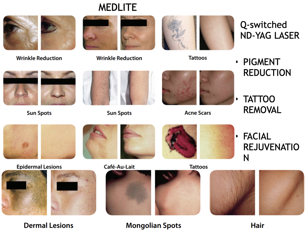 PIGMENTARY DISORDERS AND TATTOO REMOVAL - Images to update.004