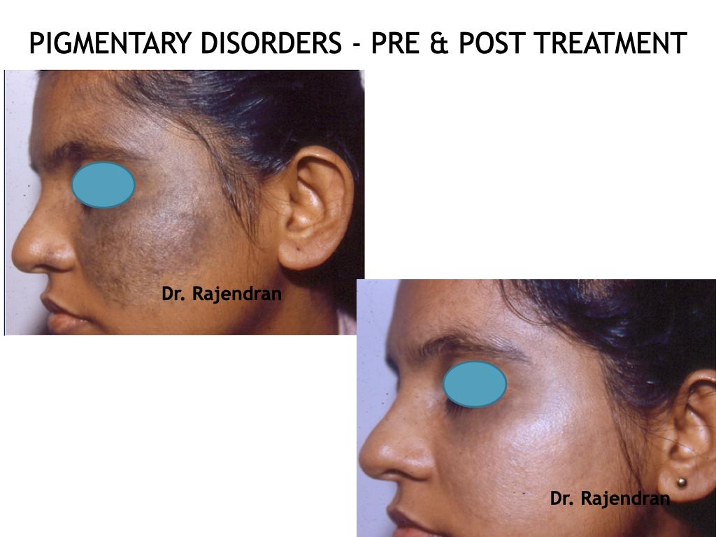 PIGMENTARY DISORDERS AND TATTOO REMOVAL - Images to update.005