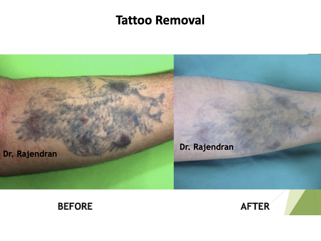 PIGMENTARY DISORDERS AND TATTOO REMOVAL - Images to update.006
