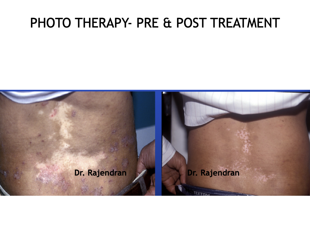 Phototherapy.004