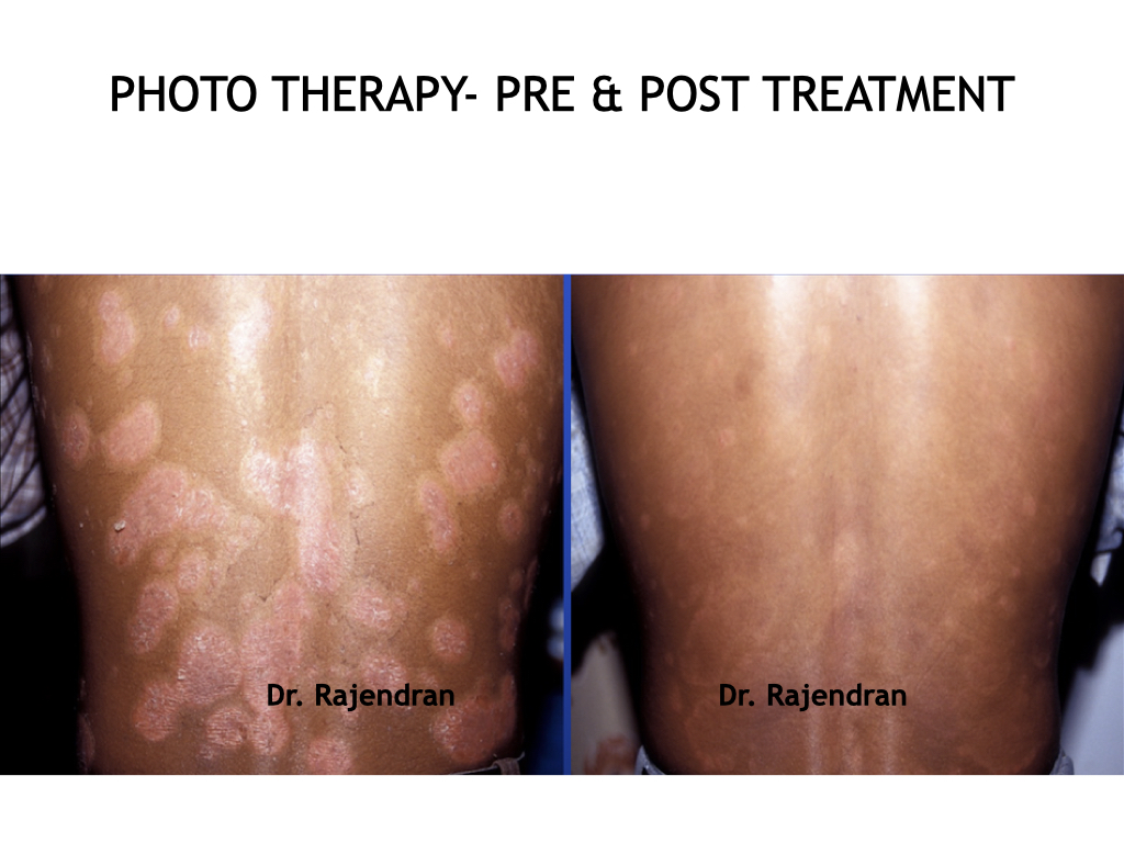 Phototherapy.005